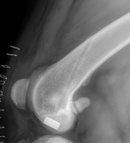 Synacart cartilage implant on the femoral condyle